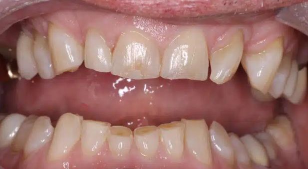 Smile before treatment: crooked, discolored teeth with gaps