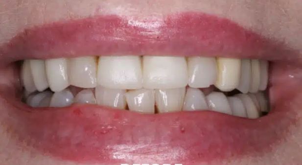 Smile before treatment: uneven teeth with a gap
