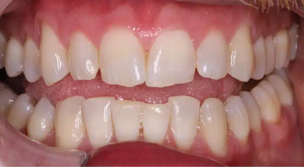 Smile before treatment: worn, uneven front teeth