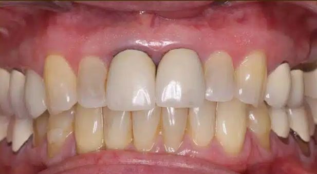 Smile before treatment: discolored front crowns