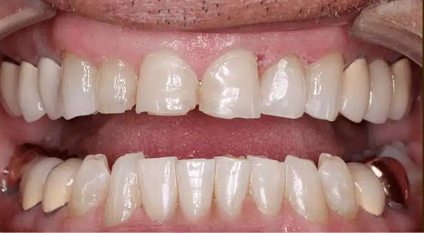 Smile before treatment: worn teeth with older restorations