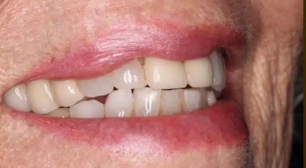 Smile before treatment: worn side teeth