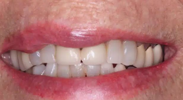 Smile before treatment: worn, uneven teeth