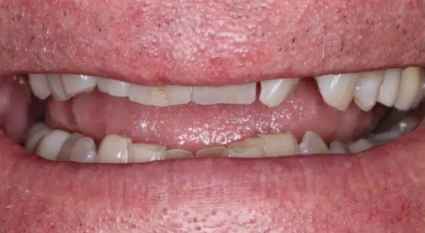 Smile before treatment: missing and worn teeth