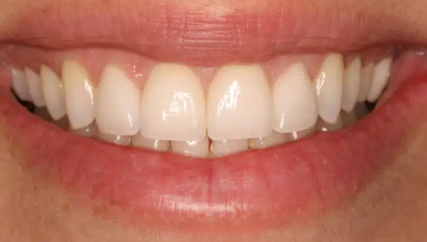 Smile after treatment: restored, even upper front teeth