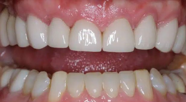 Smile after treatment: straight, white teeth