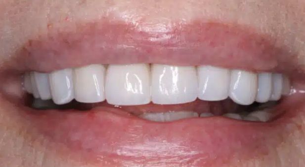 Smile after treatment: even, closed smile line
