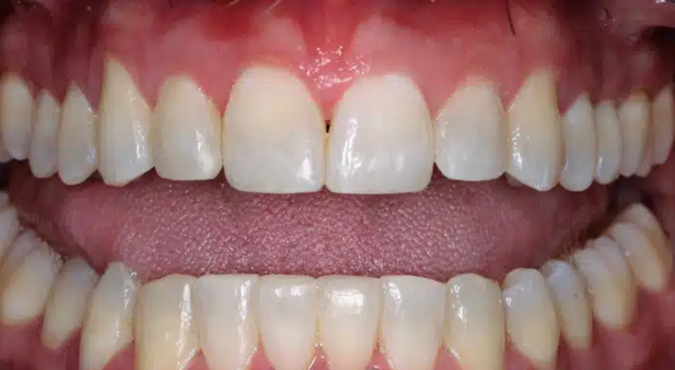 Smile after treatment: restored front teeth