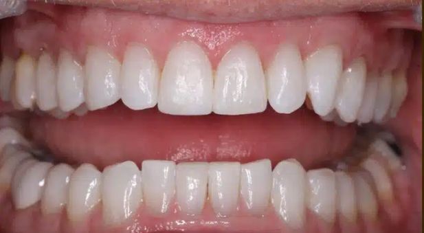 Smile after treatment: bright, even upper and lower teeth