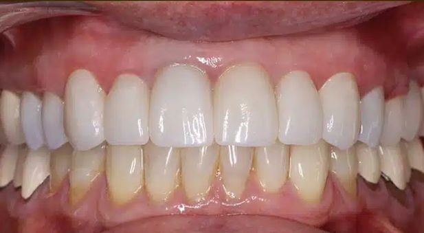 Smile after treatment: matching, natural-looking front teeth