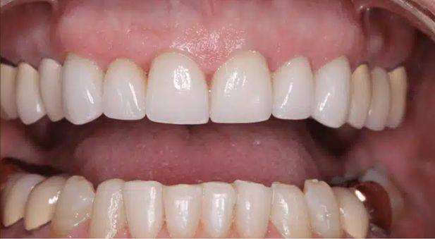 Smile after treatment: restored, even teeth