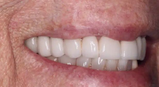 Smile after treatment: restored, even smile