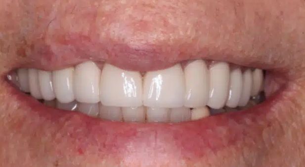 Smile after treatment: even, bright smile