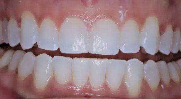Smile after treatment: bright, even teeth