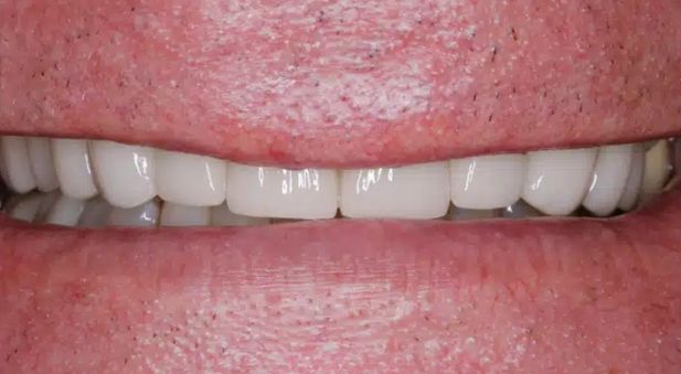 Smile after treatment: a full, even row of teeth