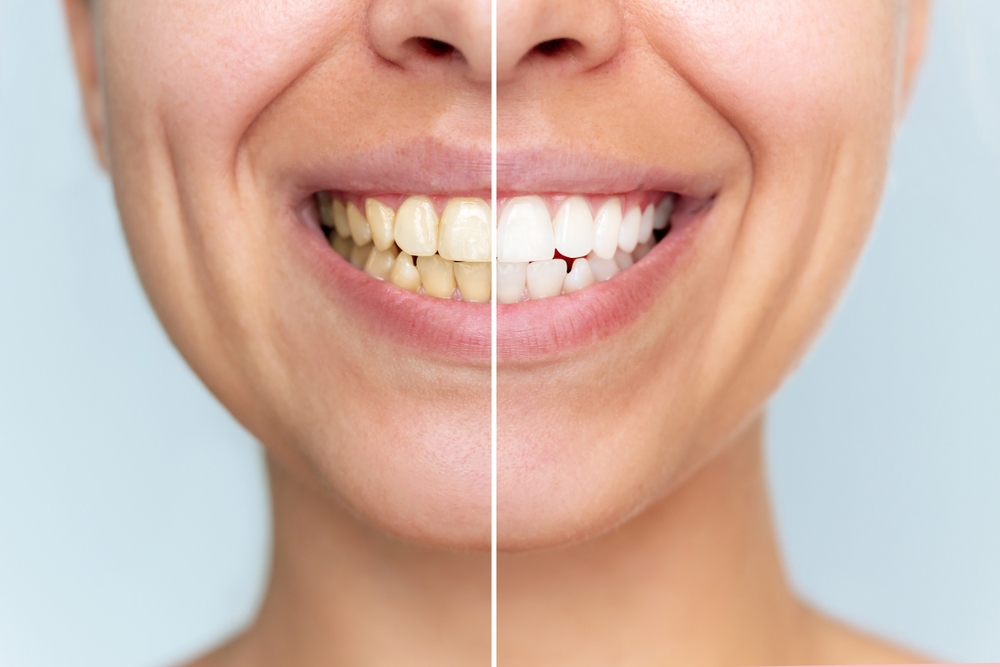 Teeth Whitening Clemente